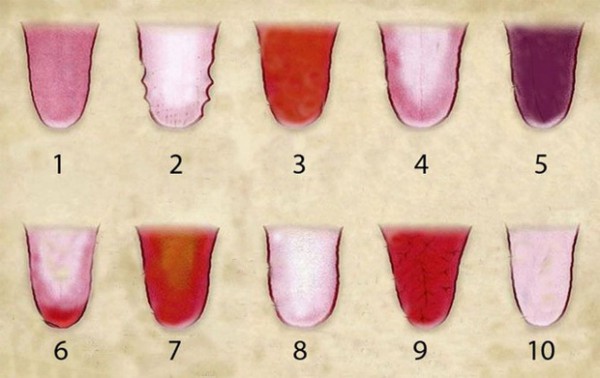 teeth marks on swollen tongue