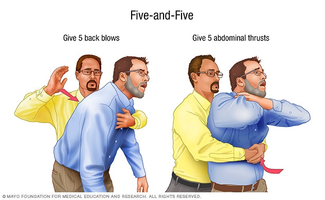 First aid for a choking person