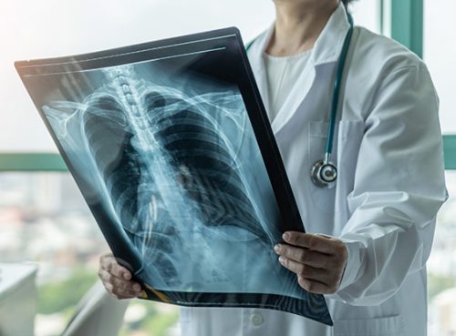 mesothelioma Lung Cancer Imaging