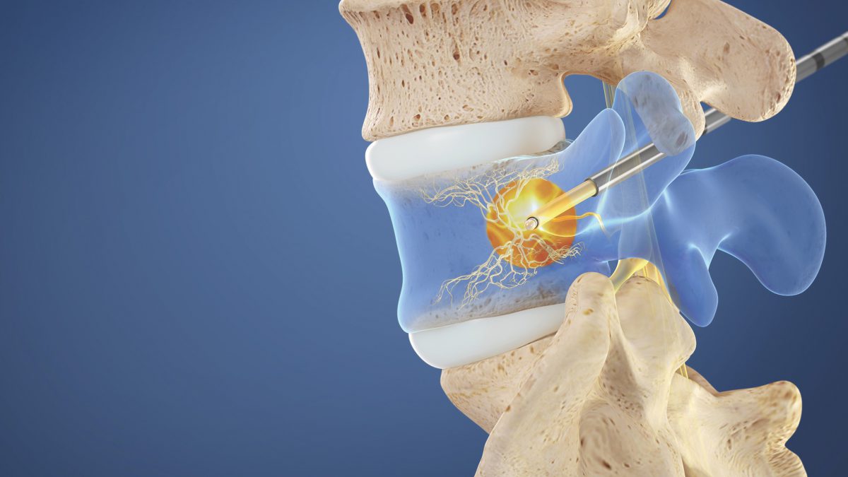 St. Elizabeth Healthcare Spine Center Spinal Intracept Procedure