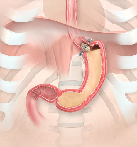 LINX™ Surgical Treatment Option for GERD. Magnetic Sphincter Augmentation (MSA) LINX™ Procedure. LINX Anatomy Graphic Sleeve Bolus.