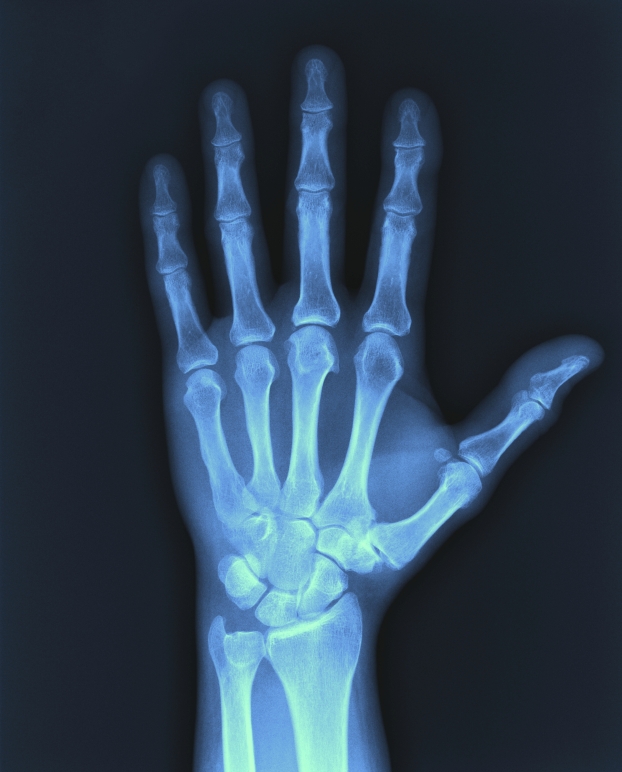 Sprain or fracture? You need to know | Healthy Headlines