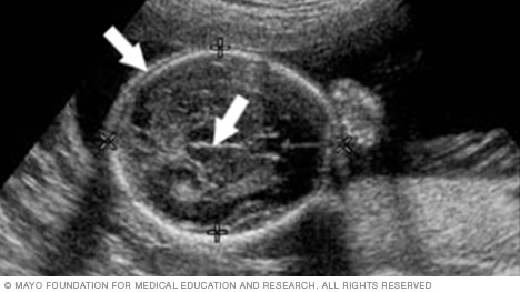 Ultrasound image showing a fetus