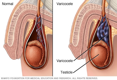 Varicocele