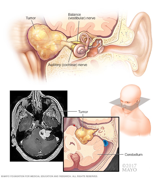 Acoustic neuroma (vestibular schwannoma)