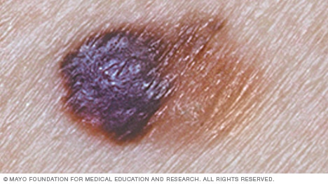 Melanoma with asymmetrical shape