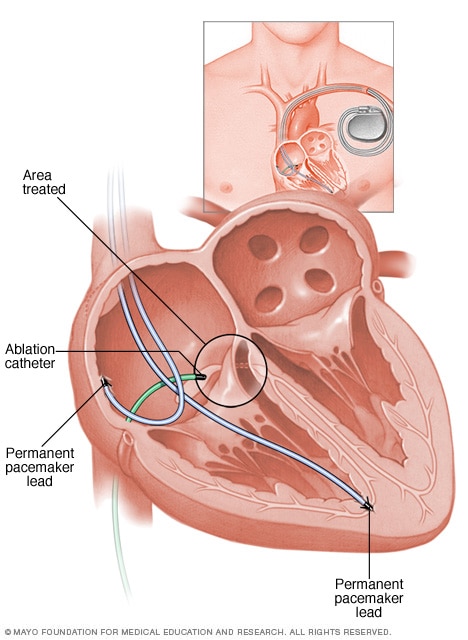 A heart during AV node ablation