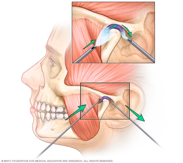 Arthrocentesis for TMJ