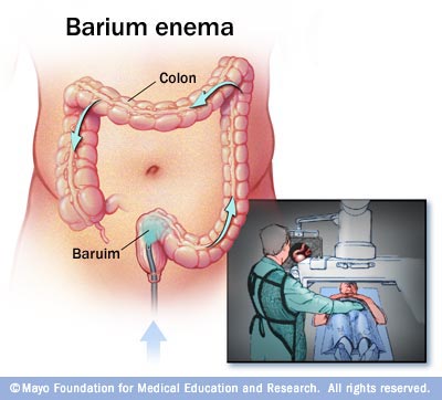Illustration of barium enema