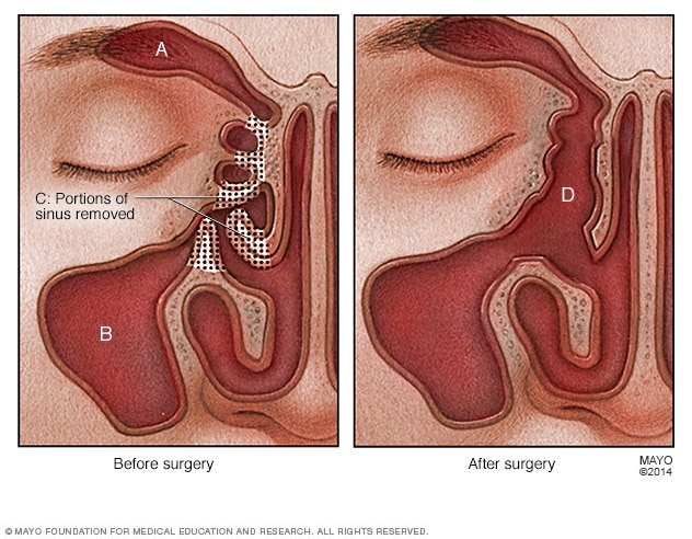 Endoscopic sinus surgery