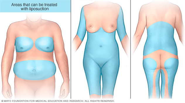 Areas on the abdomen, chest, back, legs and arms that can be treated with liposuction