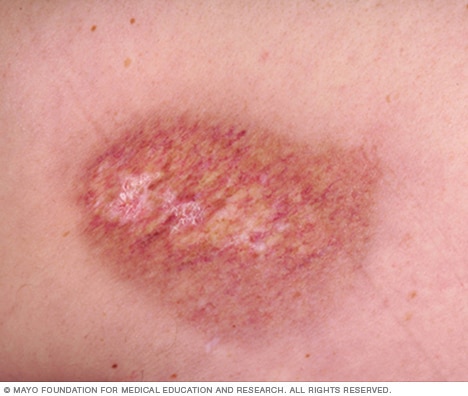 A radiation burn