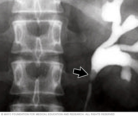 X-ray image of kidney stone