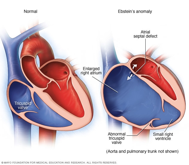 Ebstein anomaly