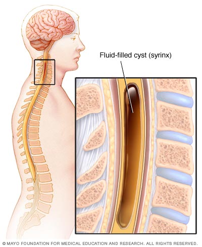 Syringomyelia