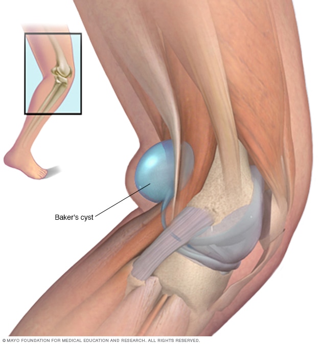 Illustration showing Baker cyst