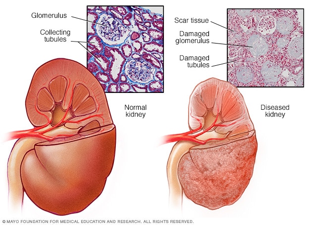 A healthy kidney and a diseased kidney