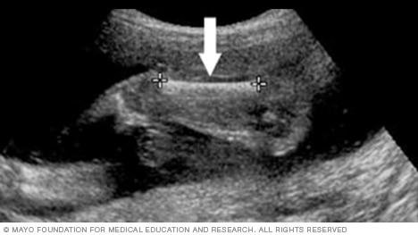 Ultrasound image showing the length of a fetus