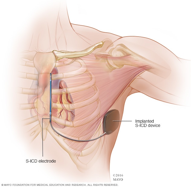 Subcutaneous implantable cardioverter-defibrillator (S-ICD)