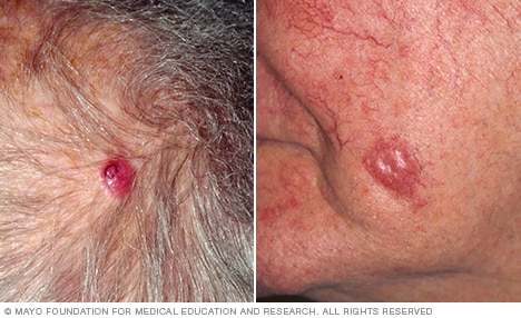 Merkel cell carcinoma