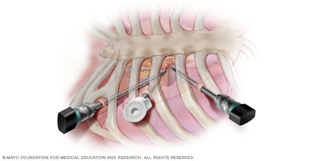 Minimally invasive heart surgery