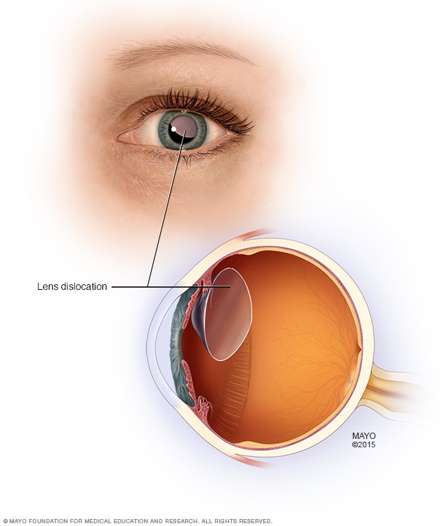 A dislocated lens within the eye