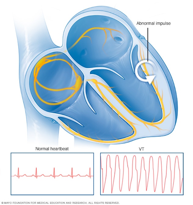 Ventricular tachycardia heartbeat