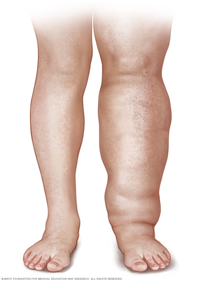 A person with leg lymphedema