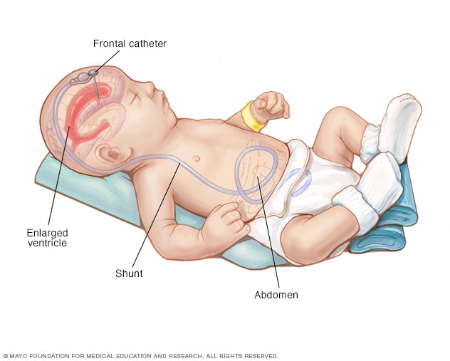 Shunt system 