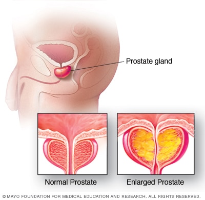 Enlarged prostate compared with prostate at usual size