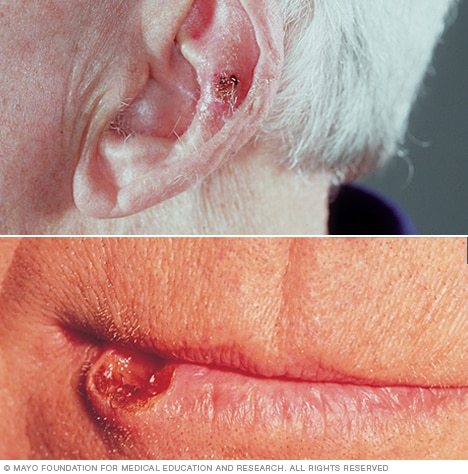 Squamous cell carcinoma on the ear and on the lip