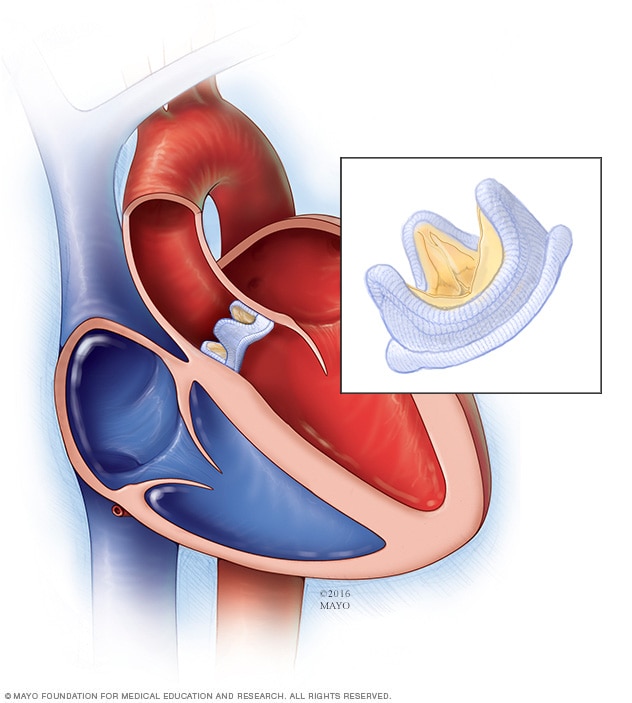 Biological valve replacement