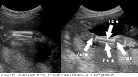 Ultrasound image showing a fetus