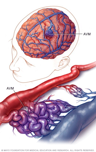 Blood vessels in brain AVM