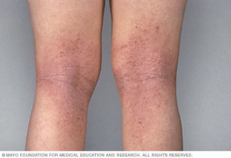 Atopic dermatitis on the legs