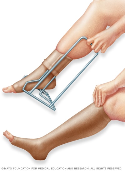 Compression stockings