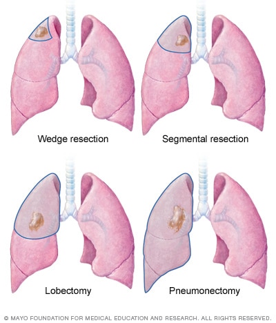 Lung cancer surgery