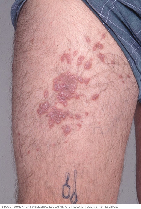 A granuloma