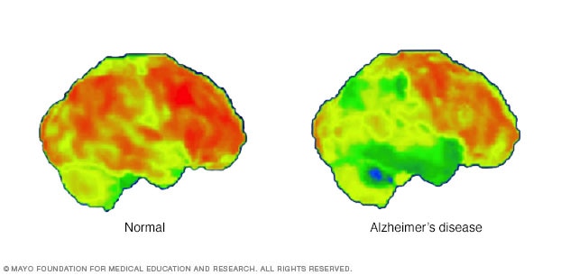 PET scans of the brain for Alzheimer