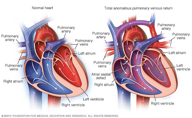 Total anomalous pulmonary venous return