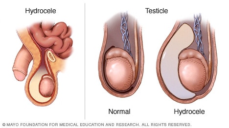 Hydrocele