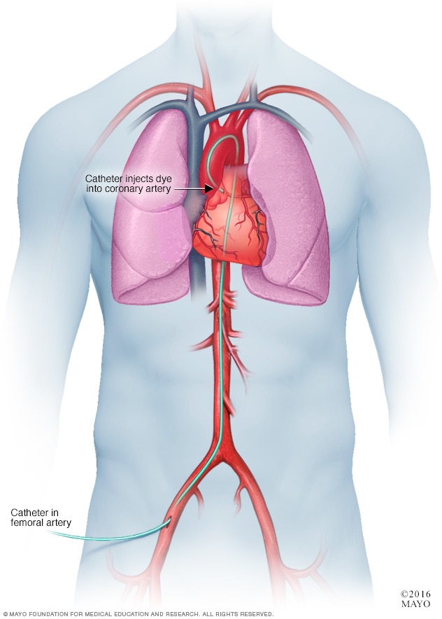 Coronary angiogram