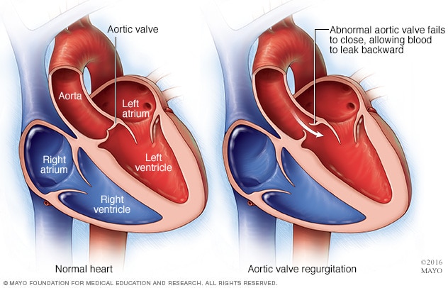 Aortic valve regurgitation