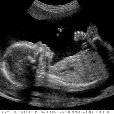 A fetal ultrasound slide showing baby