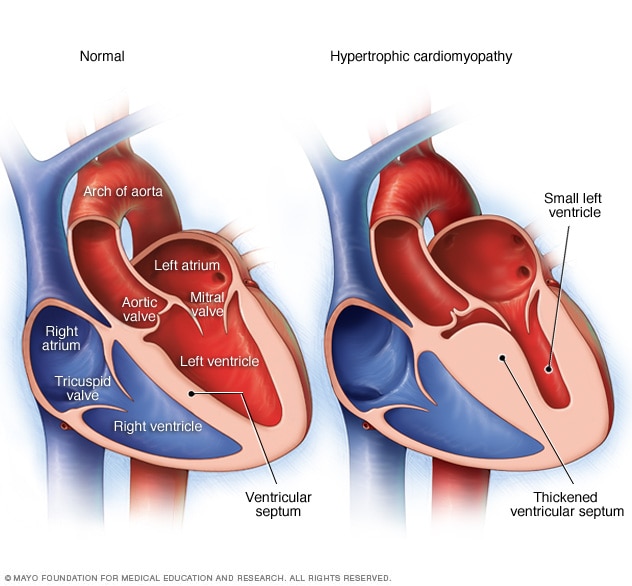 Hypertrophic cardiomyopathy