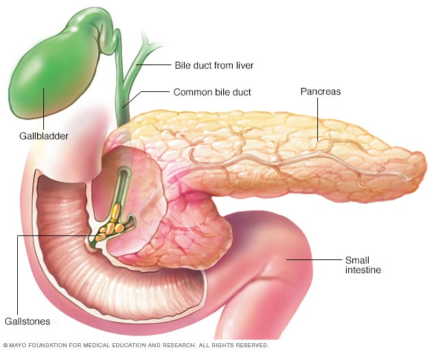 Pancreatitis caused by gallstones 