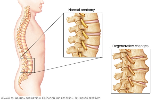 Bone spurs and narrowed disks in the spine
