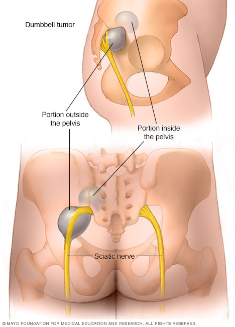 Complex nerve sheath tumor in the shape of a dumbbell