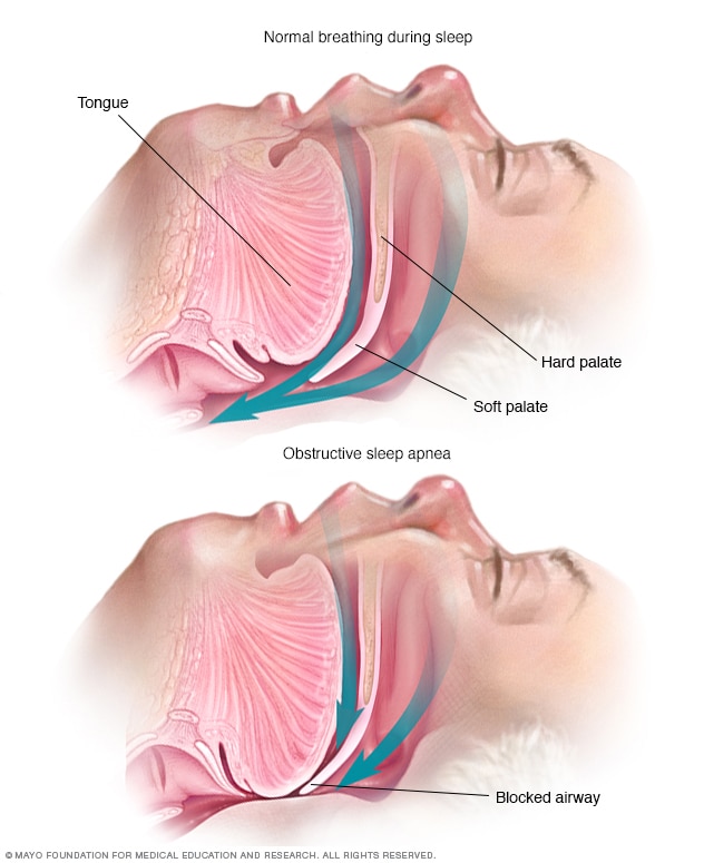 An open airway during typical breathing during sleep and a blocked airway in someone who has obstructive sleep apnea.