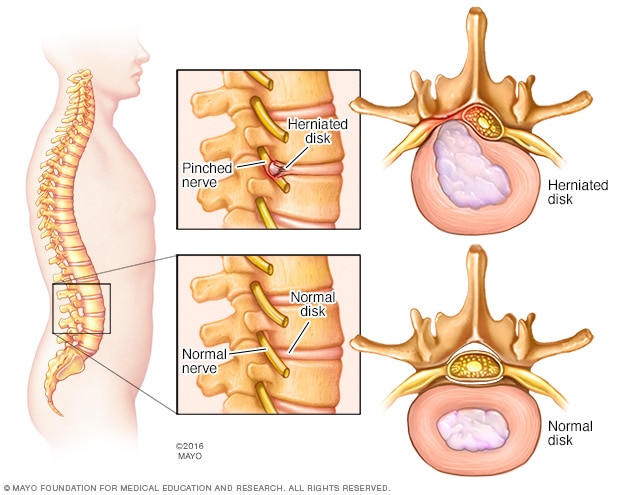 Herniated disk